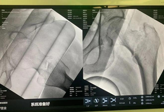 最新骨折话题，观点阐述与深度分析